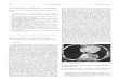 Síndrome general, como presentación de un Streptococcus ...scielo.isciii.es/pdf/ami/v23n4/carta4.pdf · caso de un paciente varón de 47 años de edad, fumador de 20 paquetes/ año,