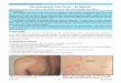 Dermatophyte Infections An Update - WordPress.com · 2016-04-06  · concentricum and is called as tinea imbricata (Fig.2) papulopustules over the buttocks/shins: due to exten-sive