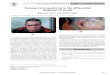 Ramsay-Hunt syndrome in the differential diagnosis of strokeunsuccessful isolation of varicella zoster virus (VZV). The patient was treated with acyclovir (800mg 5 times daily) and