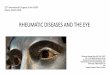 RHEUMATIC DISEASES AND THE EYE - Livemedia.gr...RELAPSING POLYCHONDRITIS (RP) ... •Preliminary criteria for the classification of the antiphospholipid syndrome* • 1. Vascular thrombosis