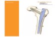 Surgical Technique - Smith & Nephewthe femoral neck and head Integrated Interlocking Lag and Compression Screws in figure eight formation for superior stability and linear compression