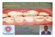 Effect of dental fluorosis on intelligence of tribal ... · Effect of dental fluorosis on intelligence of tribal Children in barkagaon, hazaribag, Jharkhand, India Presented By :