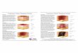 Staging Guide 092208 - Indiana · DEEP TISSUE INJURY Purple or maroon localized area of discolored intact skin or blood-filled blister due to damage of underlying soft tissue from