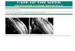 CASE OF THE WEEK - WordPress.com hyperintensity and the central dot sign. Also notice the involvement of the complete cross section of the spinal cord. Acute complete transverse myelitis