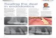 Sealing the deal in endodontics - The Endodontic Practice · Sealing the deal in endodontics T HE integrity of coronal seal is important in endodonti cs before, during and aft er