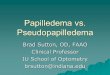 Papilledema vs. Pseudopapilledema and these areas can have some internal reflectivity from borders The old concept of a hypoflective fluid wedge at the edge of the nerve in true papilledema