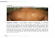 Case 20 Past history - med.mahidol.ac.th · Lymph node: No palpable cervical, supraclavicular, axillary,and inguinal lymph nodes Abdomen: No hepatosplenomegaly Skin examination -