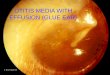 OTITIS MEDIA WITH EFFUSION (GLUE EAR) · OTITIS MEDIA WITH EFFUSION (GLUE EAR) Detail of the Eustachian tube, cartilaginous to the Rt, bony Lt, demonstrating dimensions. The bony