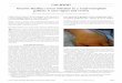Invasive Bacillus cereus infection in a renal transplant ...downloads.hindawi.com/journals/cjidmm/2012/461020.pdf · B cereus food poisoning in immunocompromised patients, both of