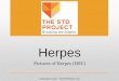 Herpes - 42y6v737ug6cgtp1x1mmauet-wpengine.netdna-ssl.com · THE STD PROJECT Breaking the Stigma . s- rus . Title: Chancroid Author: Do Not Use Created Date: 8/14/2017 12:32:23 PM