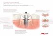 On1™ concept Product overview - Nobel Biocarenobelbiocare.md/download/81625_On1_product_overview_ENG.pdf · Product overview Simplify all restorative procedures The On1 Base moves