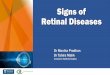 Signs of Retinal Diseases - Auckland · Signs of Retinal Vascular Disease. Lens • Vascular changes – arteriolosclerosis, AV crossing changes, ... • on the iris NVI / rubeosis