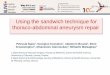 Using the sandwich technique for thoraco-abdominal aneurysm … · Using the sandwich technique for thoraco-abdominal aneurysm repair Petroula Nana 1, Georgios Kouvelos , Aikaterini
