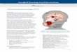 Intracerebral Hemorrhage (ICH) · Overview Intracerebral hemorrhage (ICH) is caused by bleeding within the brain tissue itself — a life-threatening type of stroke. A stroke occurs