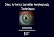 Deep Anterior Lamellar Keratoplasty - Techniques...Deep Anterior Lamellar Keratoplasty - Techniques SHERAZ DAYA MD FACP FACS FRCS(Ed) FRCOphth Financial Disclosure Company Code 1