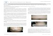 C l i n i calCas o ¢ f e r u n epor Journal of Clinical ......1. Maheswari UG, Chaitra V, Mohan SS (2013) Keratosis follicularis spinulosa decalvans: a rare cause of scarring alopecia