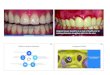 Gingival retraction/impression taking copy · 2018-03-22 · Gingival Retraction Key to Successful Impressions Affects long term gingival aesthetics 2 Gingival tissues should be in
