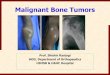 Malignant Bone Tumors - himsr.co.in · 5–10% of primary bone tumors More common than osteosarcoma in children less than 10 years of age . Site of Occurence Diaphysis/Metadiaphysis