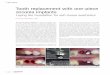 Tooth replacement with one-piece zirconia implants · invasive, and single-stage, immediate provisionalisation procedures have become more commonplace.3–10 High success rates have