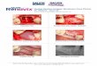 Guided Healing Collagen Membrane Case Photos Dr. Wallace ... Dr. Wallace - Case #2 Surgery & Photos: