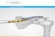 Acu-Sinchآ® Repair System - Acumed ... procedure pack which includes an Acu-Sinch Drill, an Acu-Sinch