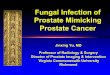 Fungal Infection of Prostate Mimicking Prostate Cancer · Teaching Points at Mp-MRI Ø Fungal infection of prostate may demonstrate a soft tissue mass with diffusion restriction in