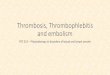 Thrombosis, Thrombophlebitis and embolism · Thrombosis, Thrombophlebitis and embolism PST 515 –Physiotherapy in disorders of blood and lymph vessels . Thrombosis •Thrombosis