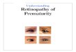 Understanding Retinopathyof Prematurity · Retinopathy of prematurity (ROP) is an eye disease, which results from abnormal devel-opment of the retina (the light-sensitive lining of