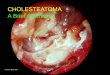 CHOLESTEATOMA A Brief Overview - queenslandotology.com€¦ · Acquired cholesteatoma is the end Stage IV of adhesive otitis, where the drum collapse has invaginated into the middle