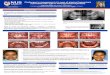Challenges in management of a case of gingival hyperplasia ... · Deep overbite (non-traumatic) with marked reduction in vertical dimension, secondary to delayed eruption of 26 and