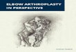 ELBOW ARTHROPLASTY IN PERSPECTIVE · understanding of elbow anatomy, kinematics and biomechanics 13, 16. Failures resulted from protrusion of the humeral stem, bone resorption, fracture