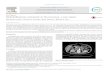 Medulloblastoma metastatic to the pancreas: a case report · Case Report Medulloblastoma metastatic to the pancreas: a case report Hemanth Gavini,1 Venkat D. Arukala,1 John Stewart,2