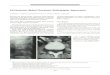Extraosseous Spinal Chordoma: Radiographic Appearance · 2014. 3. 28. · Extraosseous Spinal Chordoma: Radiographic Appearance G. Sebag,J.5 J. Dubois,2 Amia Beniaminovitz,3 A. Lelouch-Tubiana,4