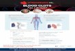 BLOOD CLOTS - HSE.ie · CLOTS IN THE LEGS (DVT - Deep Vein Thrombosis) What are the main signs and symptoms?* • Aching leg • Painful to touch, stand and walk • Part or all of