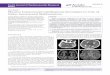 Austin Journal of Cerebrovascular Disease & Austin Full ... · including arteriovenous malformations. The most frequent paediatric . neurovascular malformations are vein of Galen