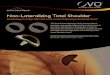 Non-Lateralizing Total Shoulder - Arthrosurface€¦ · Shoulder Case Studies. INLAY GLENOID ARTHROPLASTY Patient returned to work full time 77 days after surgery. At 3 Year follow