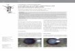 CASE REPORT / ПРИКАЗ БОЛЕСНИКА Coincidence of retinitis …srpskiarhiv.rs/global/pdf/articles-2017/maj-jun/15.pdf · 2017. 7. 9. · syndrome, ectopia lentis, Fuchs’
