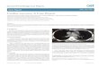 Cardiac sarcoma: A Case Report - OAText · 2019. 3. 21. · Cardiac sarcoma was defined with histopathologic examination of iliac bone biopsy. Discussion Primary cardiac sarcomas