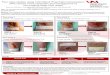 Four case studies using Intermittent Pneumatic Compression ... 2020... · Case study 1 75 year –old- gentleman –5 year duration VLU Hydrofiberdressing, compression: 2 layer bandage