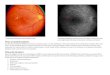 Retina Eye diseases/Epiretinal Membrane... · Web viewFluorescein Angiography is a test that documents blood circulation in the retina using fluorescein dye which luminesces under
