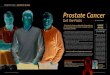 Prostate Cancer - HealthScope€¦ · 05.07.2013  · nose early. Symptoms usually arise as the cancer advances, which makes it all the more important to see a doctor if any worrisome