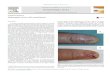 Subungual clear cell acanthoma - COnnecting REpositories · 2017. 2. 24. · Subungual clear cell acanthoma Dear Editor, A 70-year-old man presented with a painless papule on the