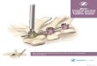 Minit® Posterior Cervical & Upper Thoracic Fixation System … · 2020. 1. 12. · 12 Minit ® Posterior Cervical & Upper Thoracic Fixation System Surgical Technique Remove it by
