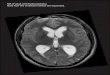 hydrocephalus in adult · 2016. 4. 18. · MR of adult with hydrocephalus Note how the ventricles (white) are expanded. Title: hydrocephalus in adult Created Date: 8/12/2014 10:02:59