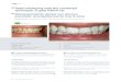 EN Teeth whitening with the combined technique: 3-year ... · Dr. Marcelo Alves Dr. Marcelo Alves Combined techniques supervised by the dentist promote interesting results and establish