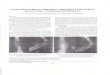 HUME FRACTURES IN CHILDREN: DIFFERENT ......2018/07/04  · from Monteggia equivalent injuries described by Bado because there are either isolated radial head dislocation or there