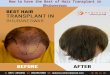 How to have the Best of Hair Transplant in Bhubaneswar