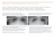 The CARESTREAM Tube and Grid Alignment System provides … · 2018. 5. 1. · Anti-Scatter Grids Improve Image Quality Scattered radiation is a major contributor to reduced image