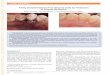 Partly Deepithelialized Free Gingival Graft for Treatment 