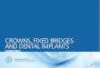 CROWNS , FIXED BRIDGES AND DENTAL IMPLANTS